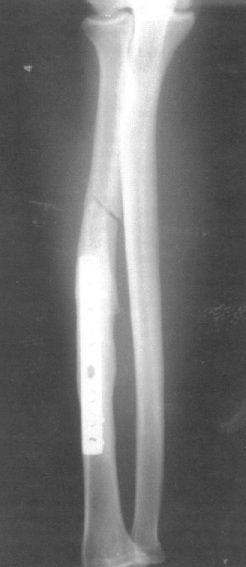 Example of a fracture near surgical plate site. (Photo from bjsportsmed.com)